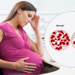 کم خونی در دوران بارداری