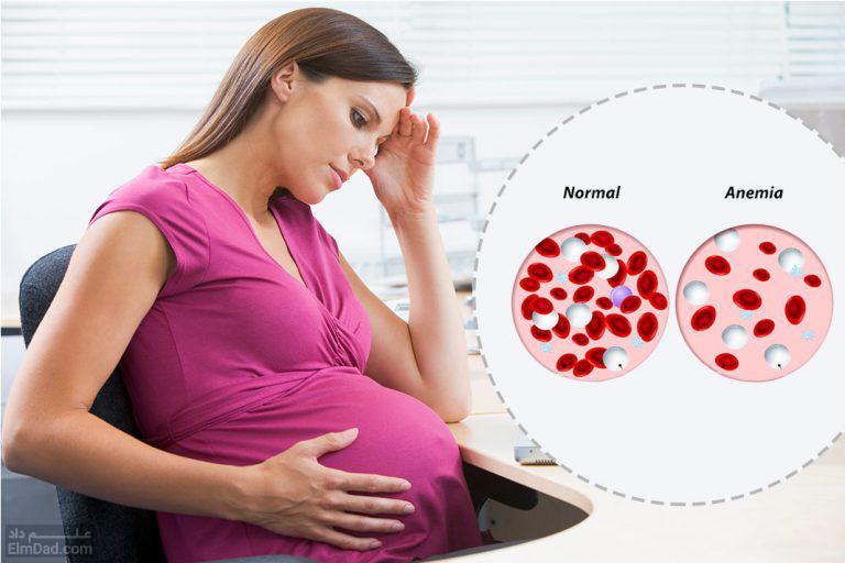 کم خونی در دوران بارداری