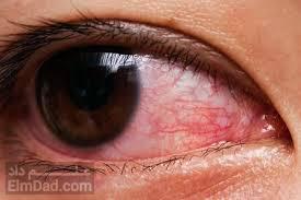 آشنایی با کاربردها، تداخلات و عوارض جانبی پروپاراکائین چشمی